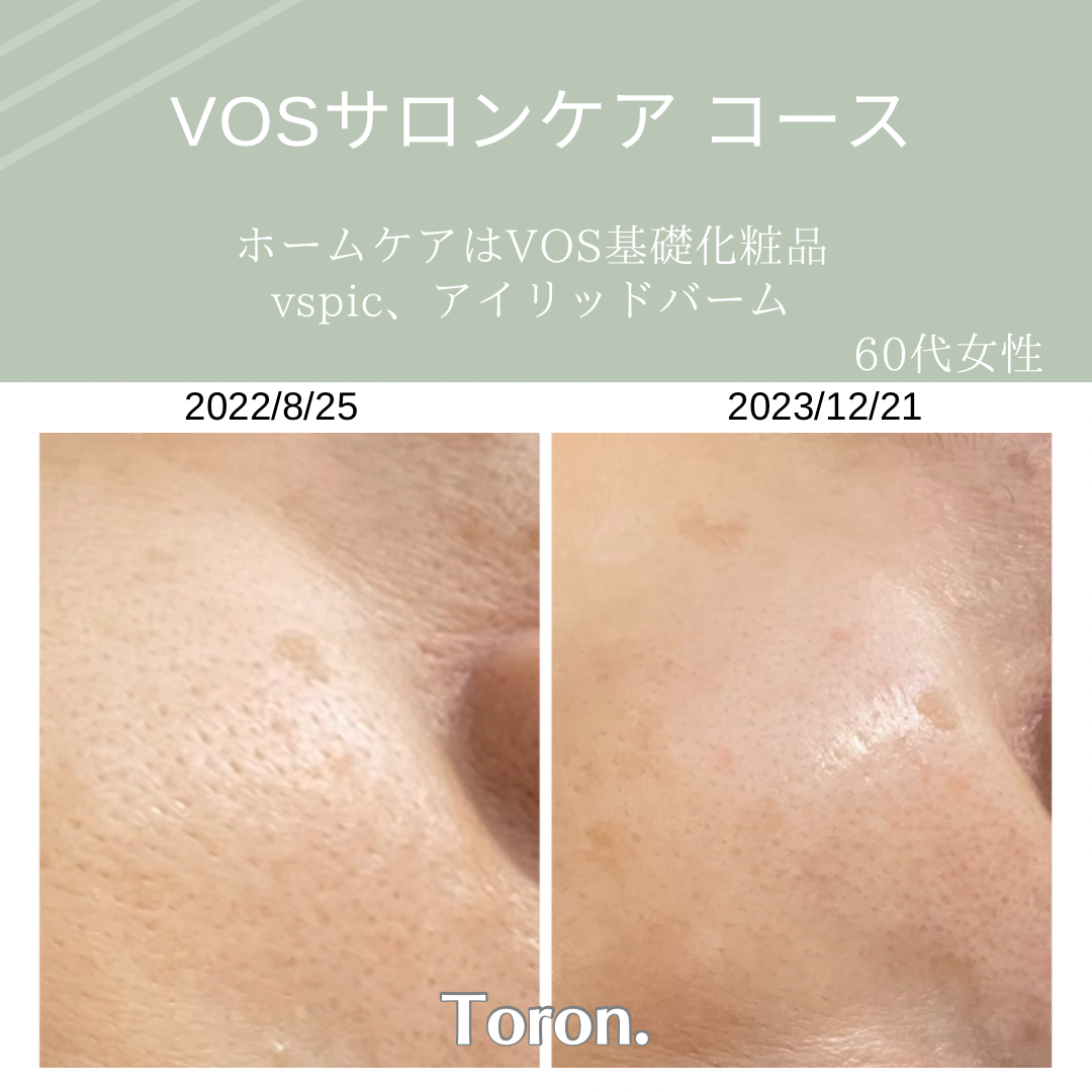 VOS | Toron.