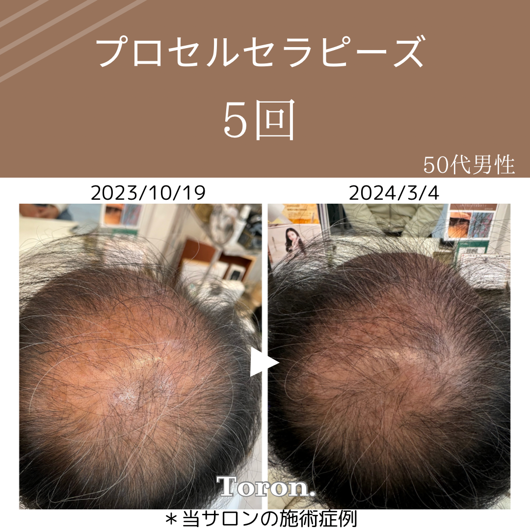 プロセルセラピーズ プロセルセラピーズ 頭皮をスピード改善し驚くほど元気にします