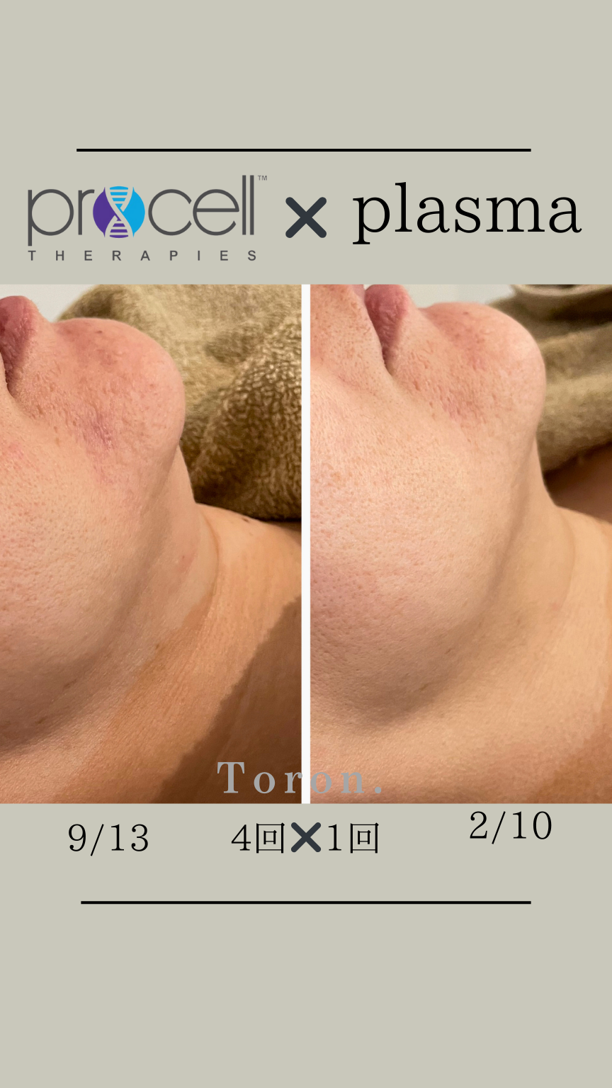 procellフェイシャル | Toron.