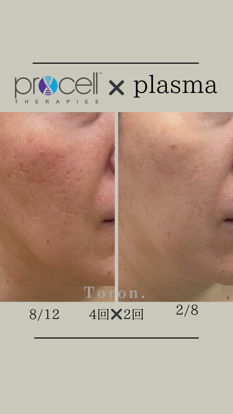procellフェイシャル | Toron.