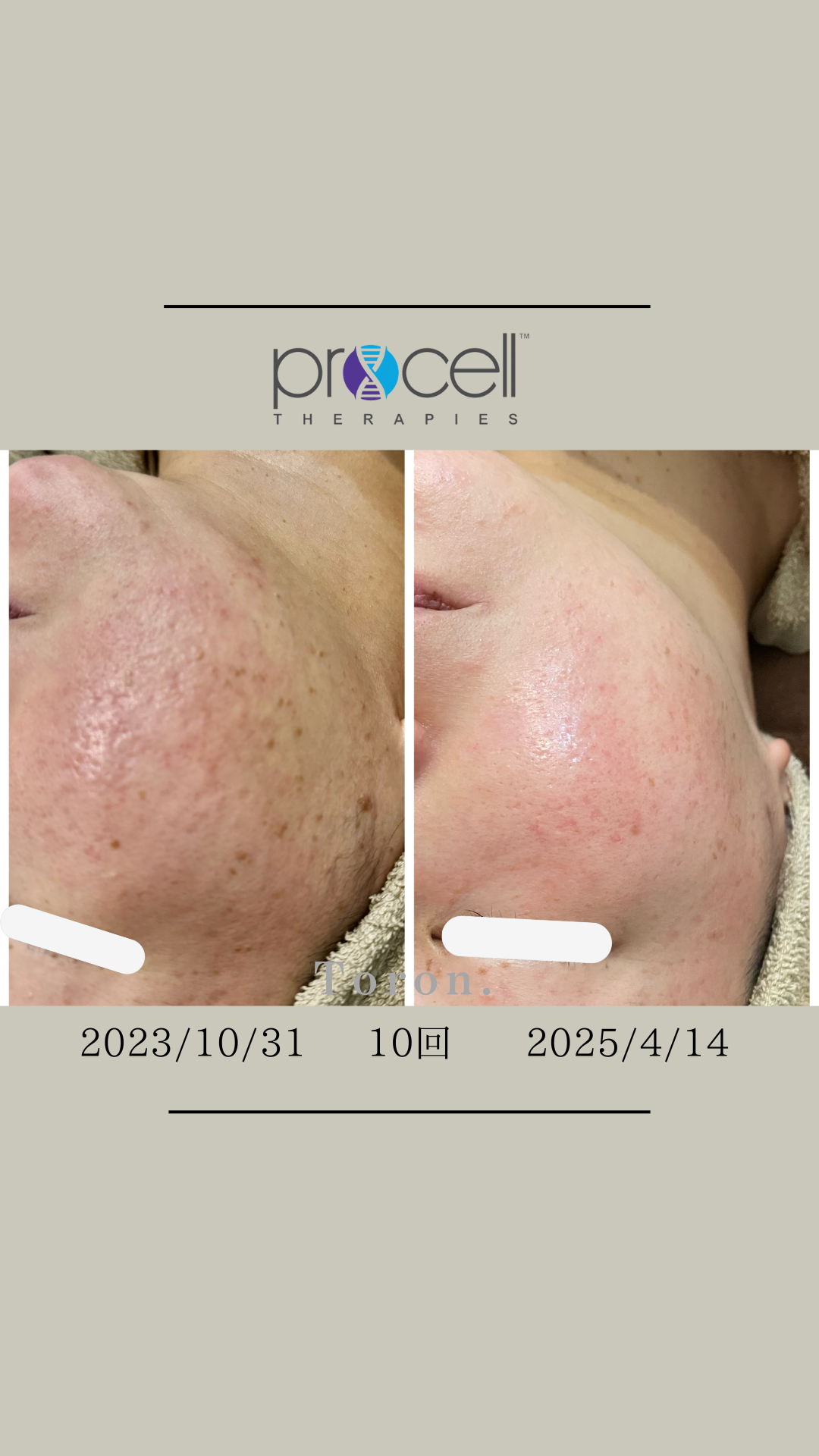 procellフェイシャル | Toron.