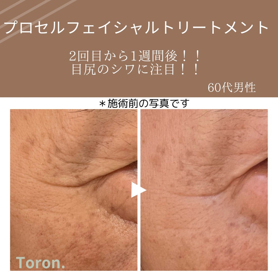procellフェイシャル | Toron.