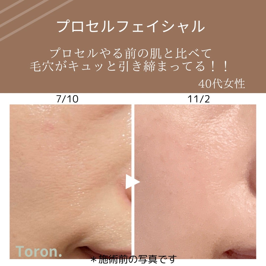 procellフェイシャル | Toron.