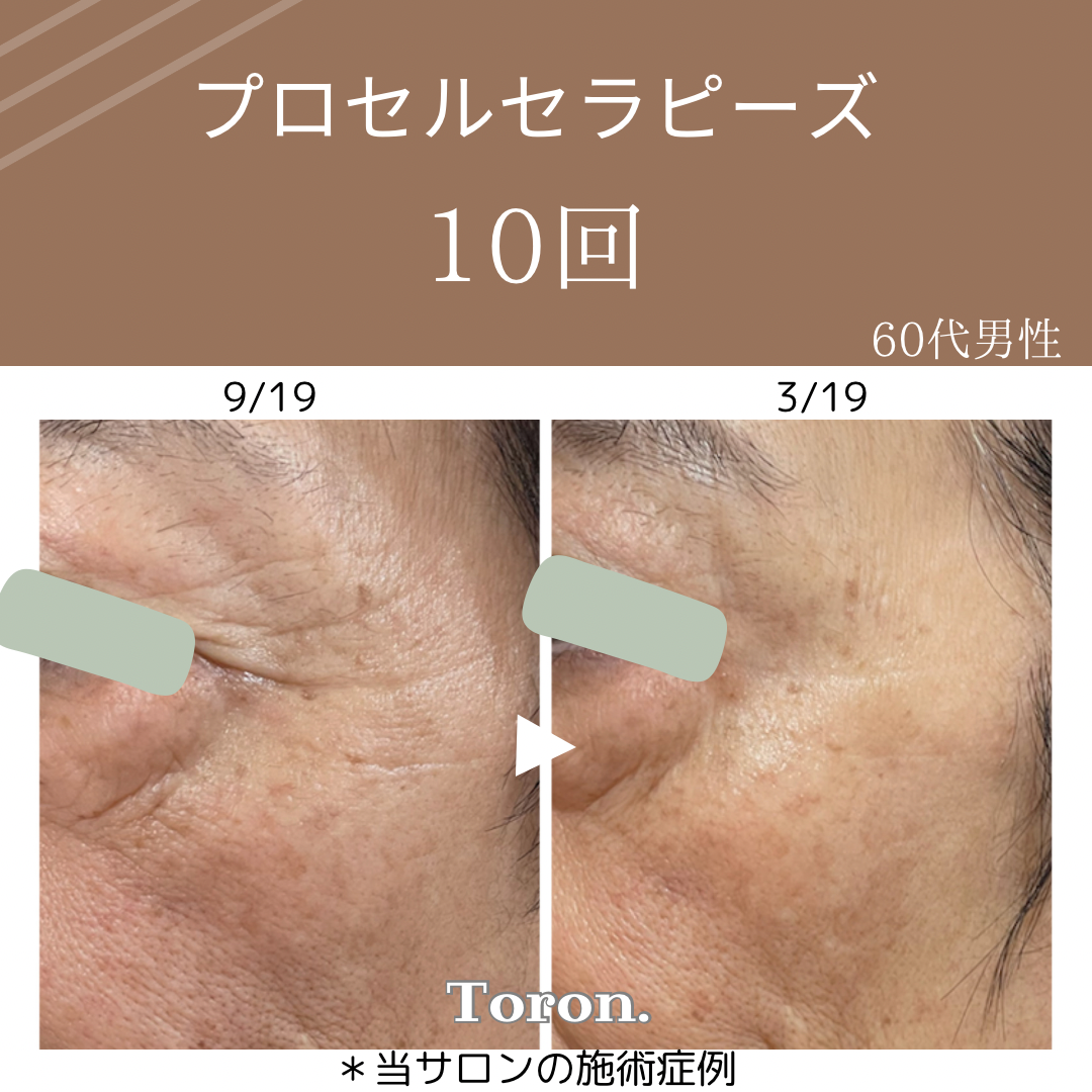 procellフェイシャル | Toron.