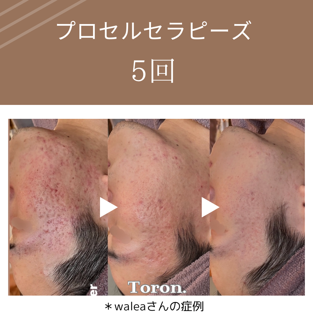 procellフェイシャル | Toron.