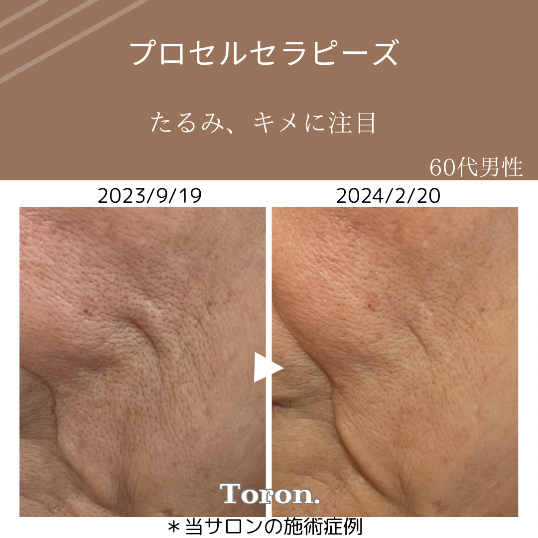 procellフェイシャル | Toron.