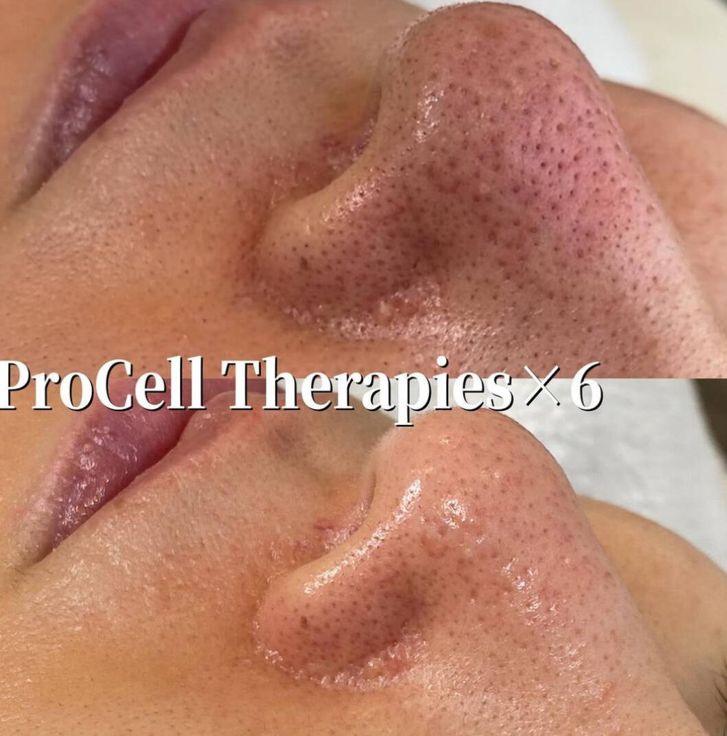 procellフェイシャル | Toron.