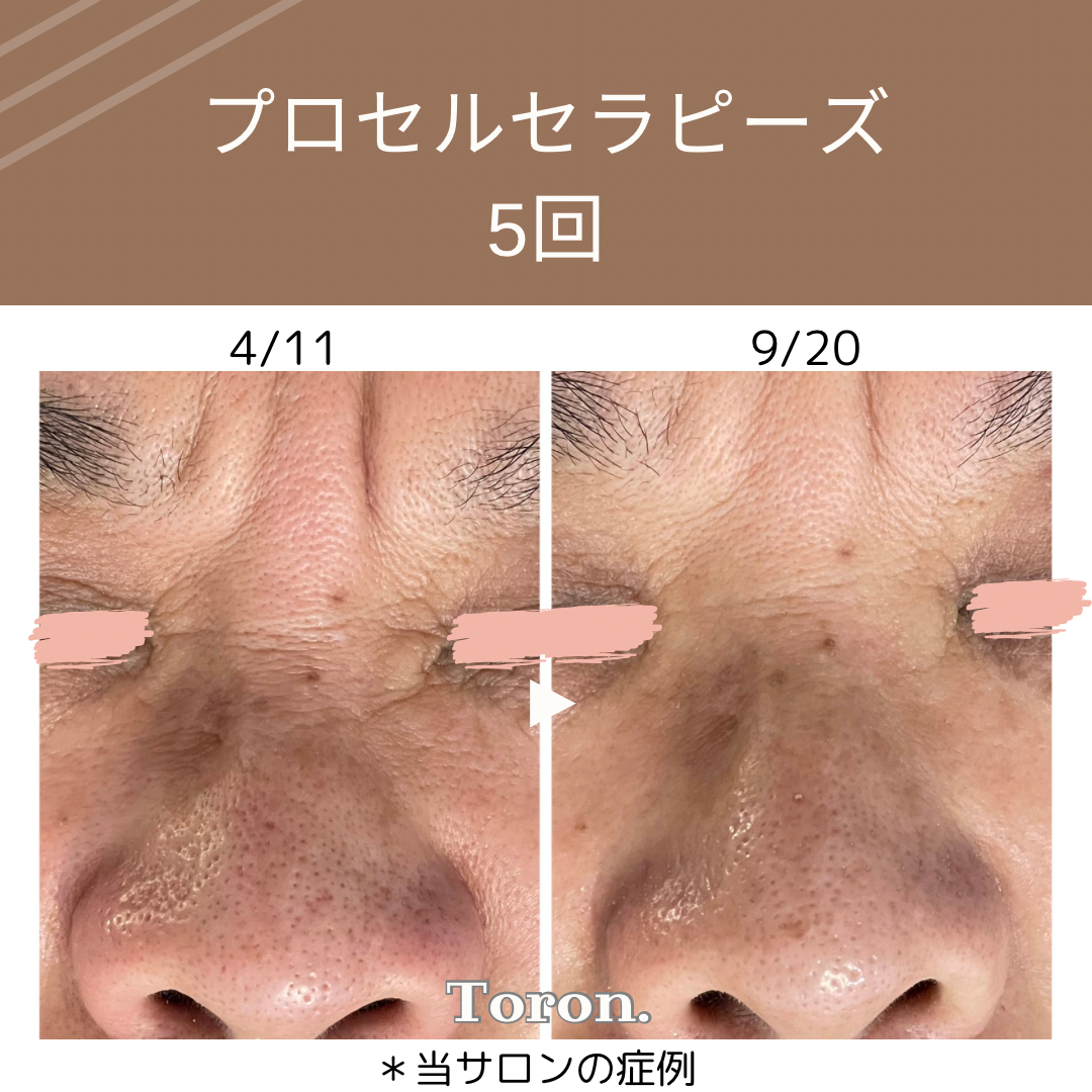 procellフェイシャル | Toron.